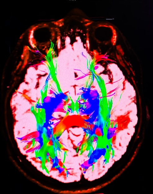 A detailed brain scan image highlighting the areas of the brain associated with memory and familiarity, such as the hippocampus and parahippocampal region. The image should be scientifically accurate and visually engaging.